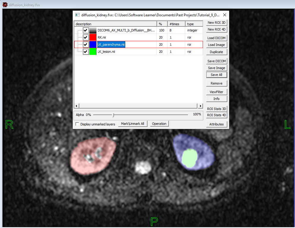 Kidney ROIs on diffusion image