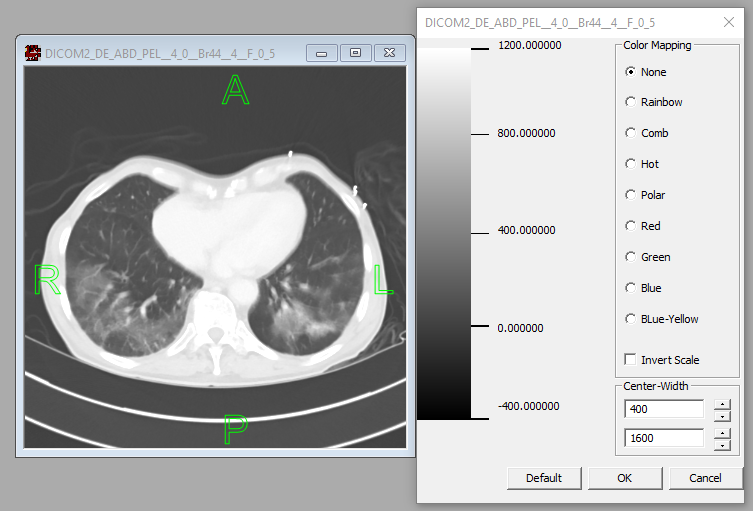 CT lung window