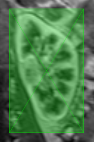 Vector ROI enclosing a kidney
